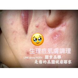 生理期一到就冒痘痘?女生常見的肌膚困擾 生理期一到就冒痘痘?女生常見的肌膚困擾