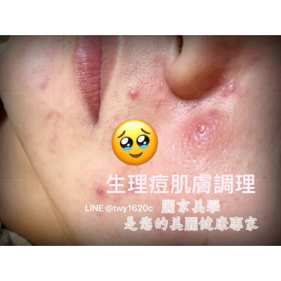生理期一到就冒痘痘?女生常見的肌膚困擾 生理期一到就冒痘痘?女生常見的肌膚困擾
