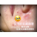 生理期一到就冒痘痘?女生常見的肌膚困擾 生理期一到就冒痘痘?女生常見的肌膚困擾